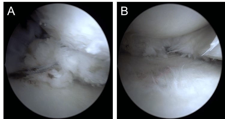 Arthroscopic comparison after medial meniscus posterior root anchor fixation and after additional meniscal centralization