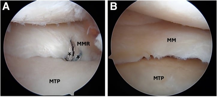 Arthroscopic tensioning of root and centralization sutures with cortical-button fixation on the tibia