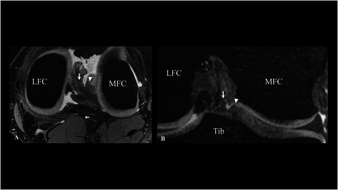 Axial and coronal 3D DESS MRI showing major and minor insertions of a double posterior lateral meniscus root