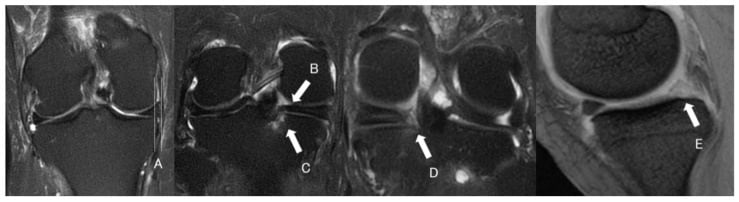 Coronal MRI measurement of medial meniscus extrusion and sagittal assessment of posterior-segment giraffe-neck morphology