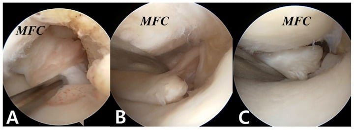 Arthroscopic examples of a stable partial medial meniscus posterior root tear a scarred complete radial tear and a complete tear with a root remnant