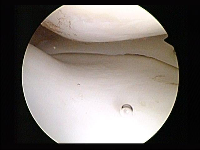 Arthroscopic view of a normal medial meniscus between the femoral condyle and tibial plateau