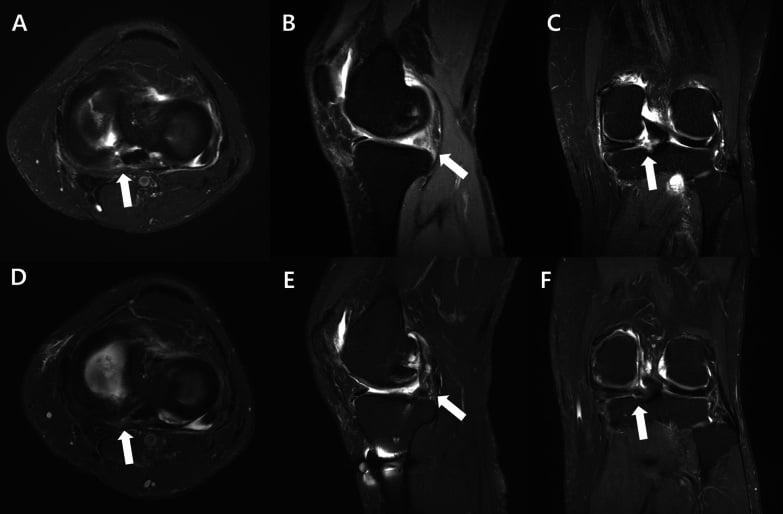 Preoperative and one-year postoperative multiplanar MRI showing a medial meniscus posterior root tear and healed repair