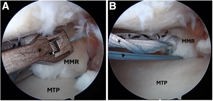 Arthroscopic passage of luggage-tag sutures through the posterior root and shuttling through the tibial tunnel