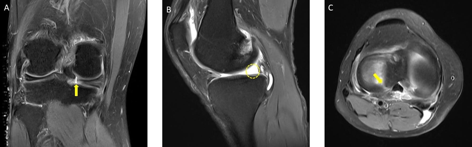 Coronal sagittal and axial MRI examples of the cleft ghost and radial tear signs of a meniscal posterior root tear