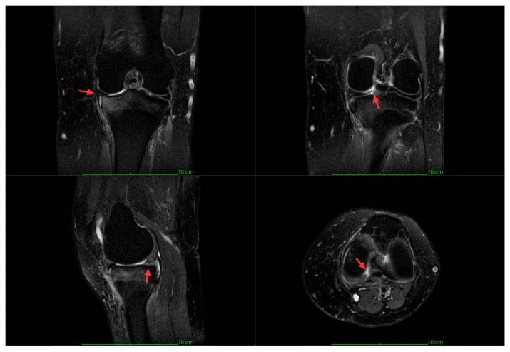 Multiplanar MRI showing medial meniscus extrusion cleft sign ghost sign radial tear and adjacent tibial subchondral oedema