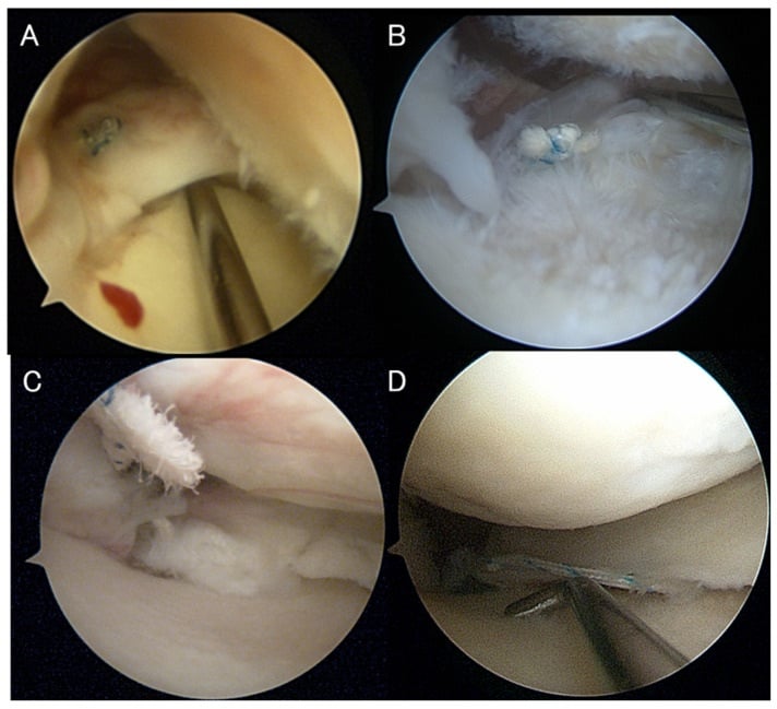 Second-look arthroscopic examples of complete lax scar and failed healing after medial meniscus posterior root repair