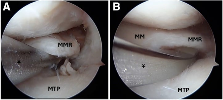 Arthroscopic creation of the medial meniscus posterior root socket and transtibial tunnel with a root guide
