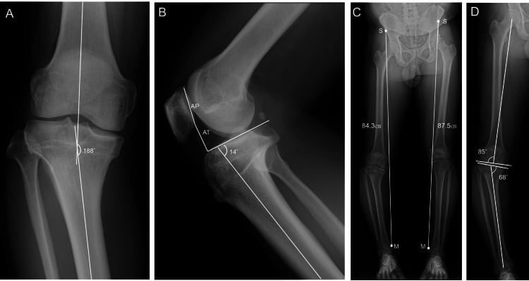 Preoperative knee and standing long-leg radiographs demonstrating varus alignment before combined root repair and osteotomy planning