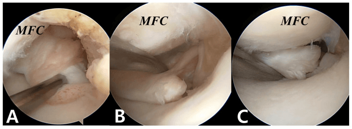 Arthroscopic views of a stable partial medial meniscus posterior root tear and two complete radial root tears