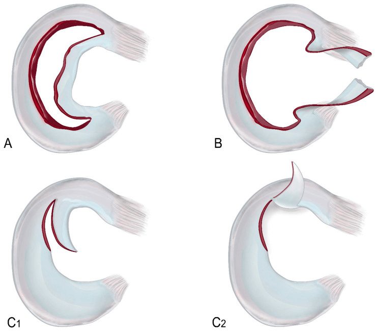 Diagram of bucket-handle, intercondylar fragment, and horizontal and vertical flap meniscal displacement