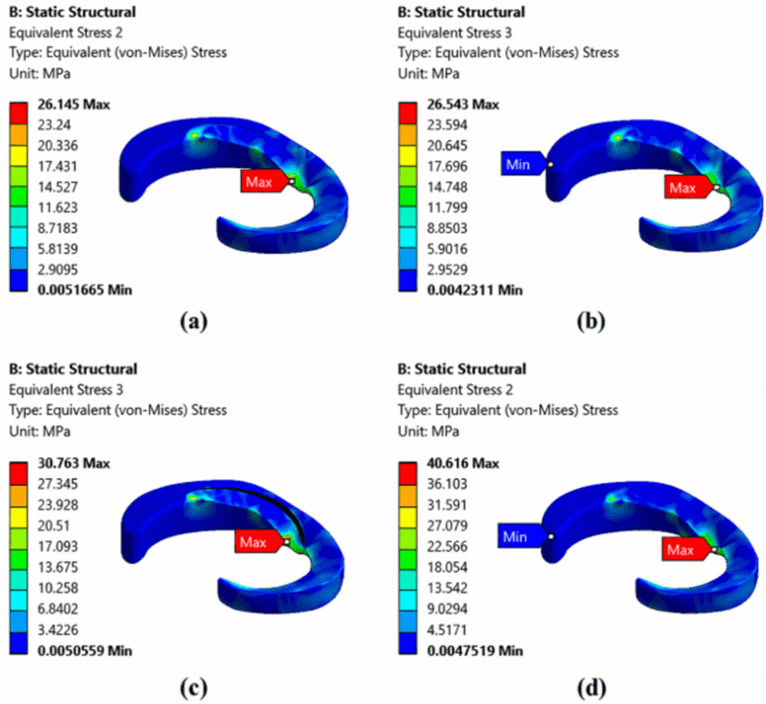 Finite-element stress distributions for healthy and torn medial menisci in four panels
