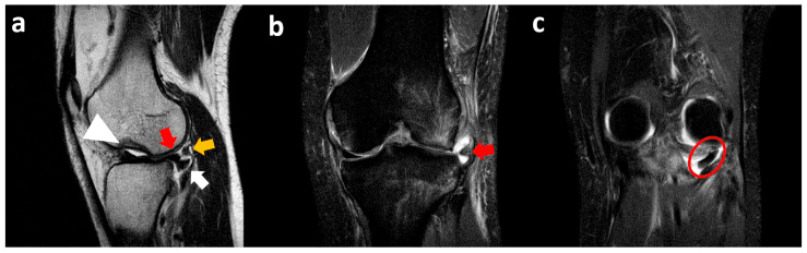 Sagittal and coronal MRI showing displaced lateral meniscal tissue in the popliteal hiatus and extrusion of the meniscal body
