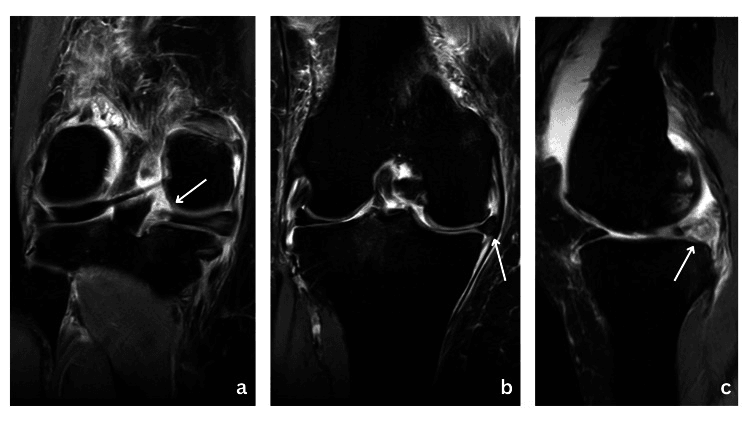 Coronal MRI of a medial meniscus root tear and extrusion, and sagittal MRI showing the ghost sign