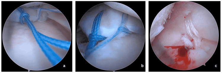 Arthroscopic transtibial medial meniscus root repair with centralisation, showing sutures in meniscal tissue and a drilled bony aperture