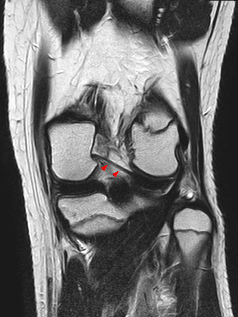 Coronal knee MRI with red arrowheads on the ligament of Wrisberg crossing the intercondylar notch