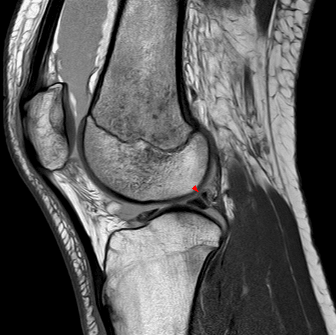 Sagittal knee MRI with a red arrowhead on the ligament of Wrisberg at the posterior horn