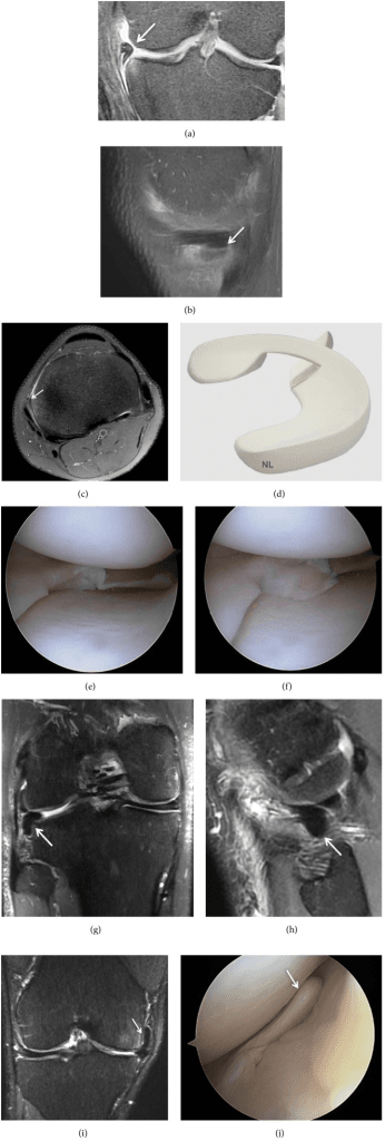 10-panel (a-j) comprehensive meniscal tear imaging review showing various tear patterns: displaced fragments on MRI (a,b,g,h,i), axial anatomy (c,d), arthroscopic views (e,f,j) demonstrating horizonta