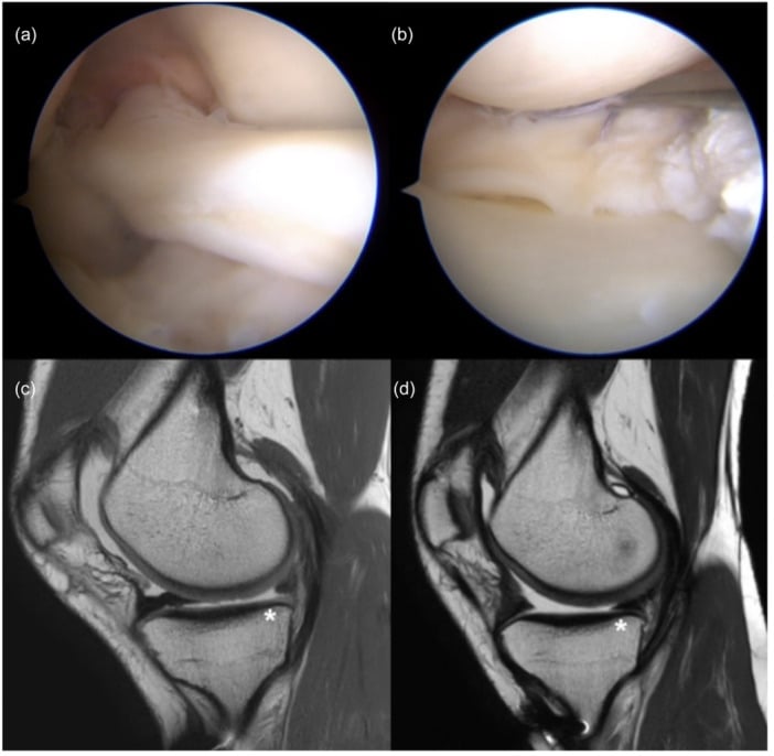Bucket-handle meniscal repair with MRI follow-up