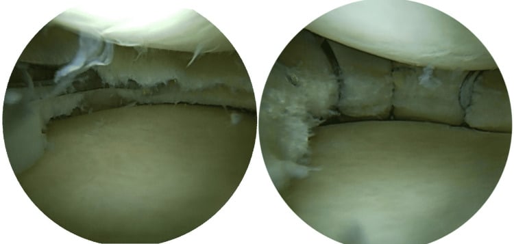 Arthroscopic repair of a horizontal meniscal tear