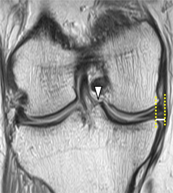 Measurement of medial meniscus extrusion