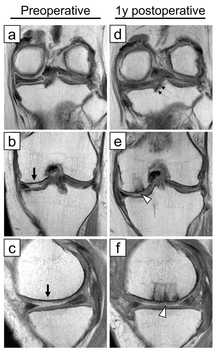 MRI healing after medial posterior-root pullout repair