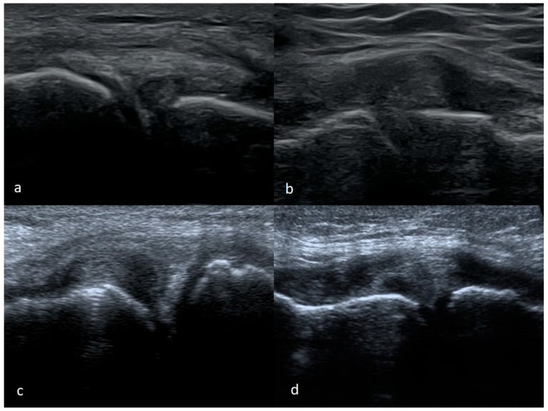 Ultrasound appearances of a meniscal flap tear