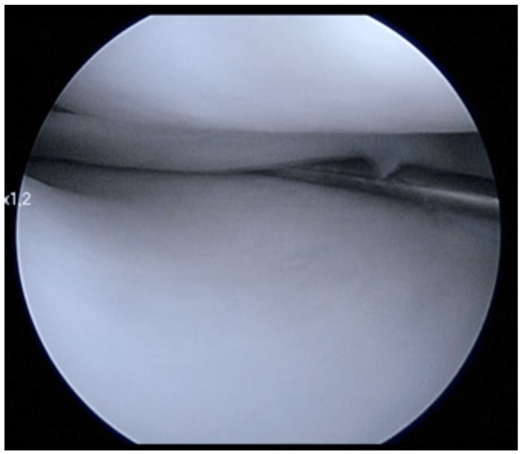Posterior-horn medial-meniscus instability on probing