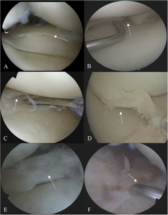 Arthroscopic meniscal tear patterns
