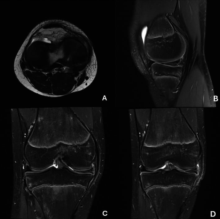 MRI patterns of vertical and horizontal meniscal tears