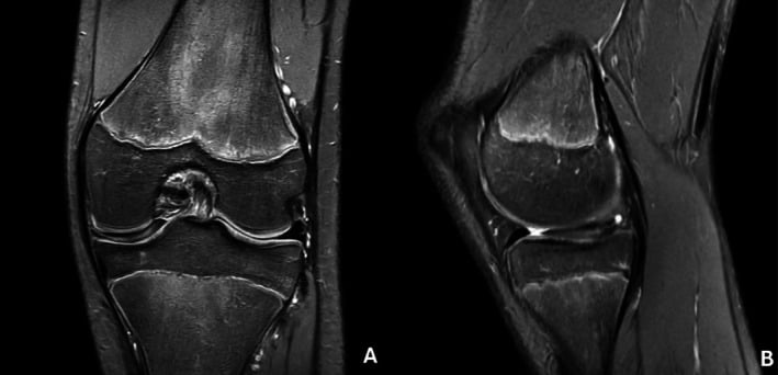 Medial parameniscal cyst on MRI