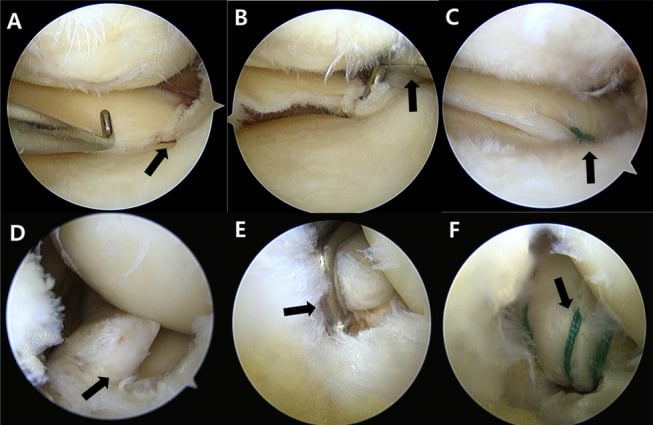 Transtibial pullout repair of a posterior meniscus root tear