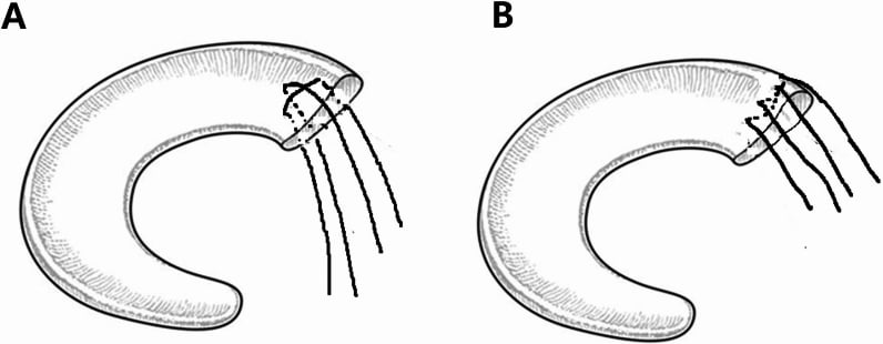 Posterior-root suture configurations