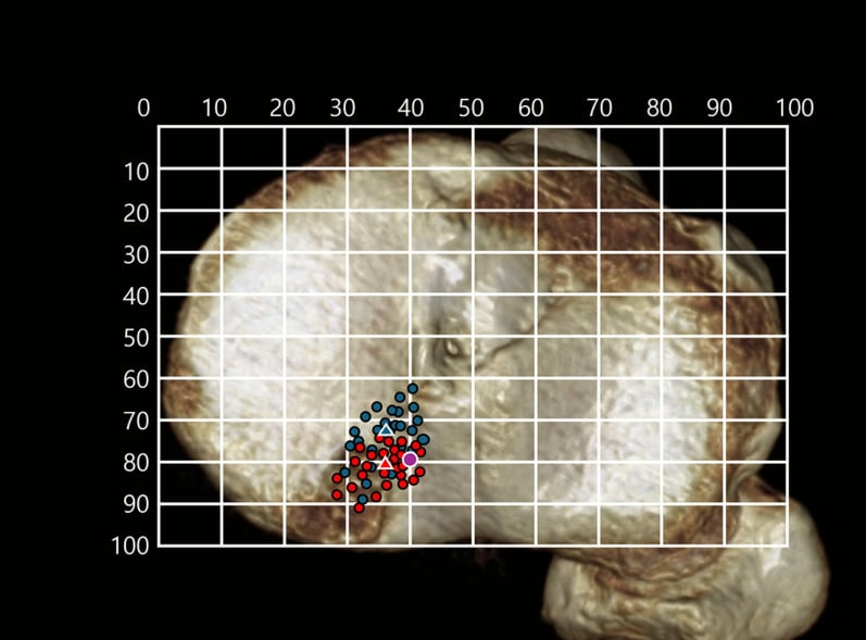 Tibial tunnel positions for posterior-root repair