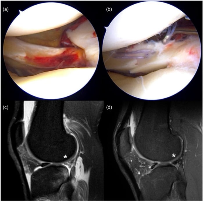 Radial posterior-horn meniscal repair with MRI follow-up