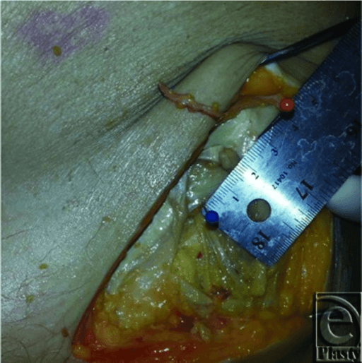 Cadaveric dissection of the lateral femoral cutaneous nerve near the anterior superior iliac spine