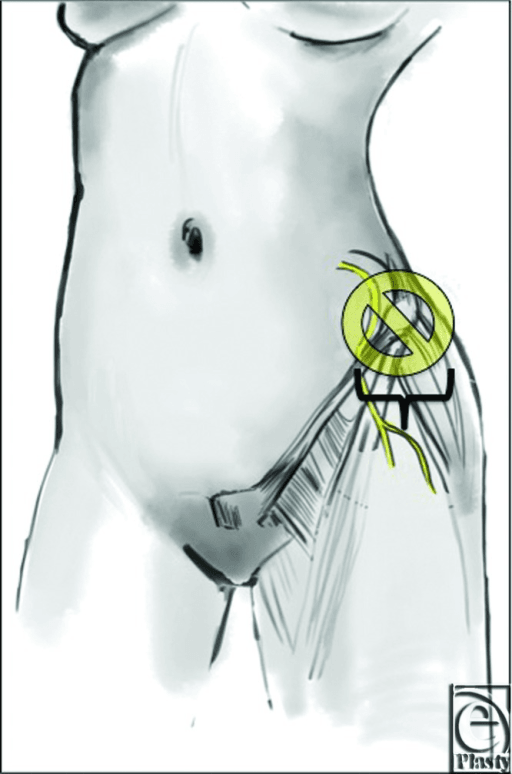 Schematic of the unsafe dissection zone for the lateral femoral cutaneous nerve at the anterior superior iliac spine