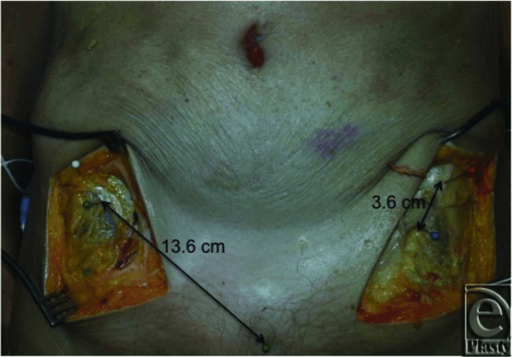 Bilateral dissection showing differing distances of the lateral femoral cutaneous nerve from the anterior superior iliac spine
