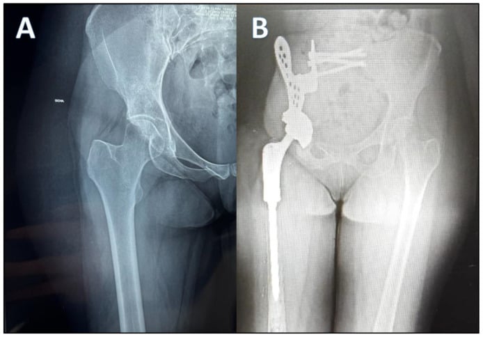 Anteroposterior pelvic radiograph of an aggressive right acetabular mesenchymal chondrosarcoma, then the same pelvis after internal hemipelvectomy and endoprosthetic reconstruction