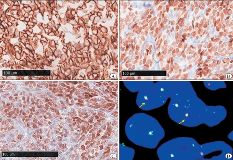 Immunohistochemistry and FISH of mesenchymal chondrosarcoma showing membranous CD99, nuclear NKX2.2 and NKX3.1, and an NCOA2 break-apart signal