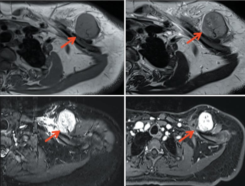 Axial T1, T2, STIR and post-contrast MRI of a lobulated extraskeletal mesenchymal chondrosarcoma anterior to the left clavicle