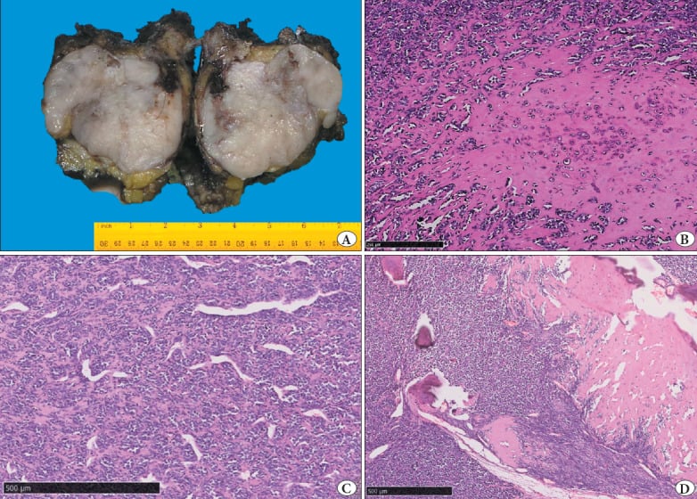 Gross specimen and histology of mesenchymal chondrosarcoma showing a lobulated grey-white tumour, abrupt cartilage islands, staghorn vessels and endochondral ossification