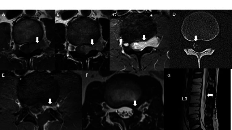 Preoperative MRI of a dumbbell mesenchymal chondrosarcoma at L2-3 with transforaminal extension, and postoperative sagittal T2 MRI