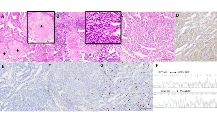 Haematoxylin and eosin, immunohistochemistry and RT-PCR traces confirming HEY1-NCOA2 in a spinal mesenchymal chondrosarcoma