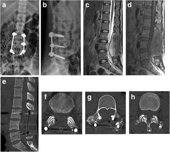 Postoperative radiographs, sagittal MRI and CT after resection of an L4 mesenchymal chondrosarcoma with instrumented reconstruction