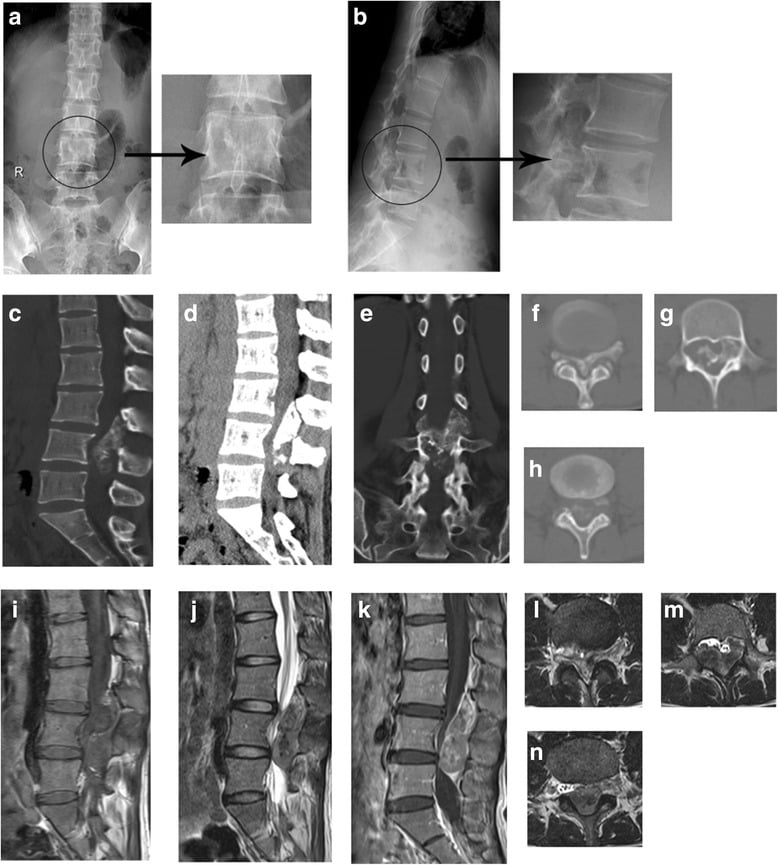 Preoperative radiographs, CT and MRI of a destructive, heavily calcified L4 mesenchymal chondrosarcoma involving the left pedicle and posterior vertebral body