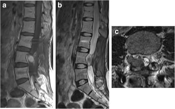Sagittal T1, sagittal T2 and axial T2 MRI five months after L4 resection showing a recurrent canal mass