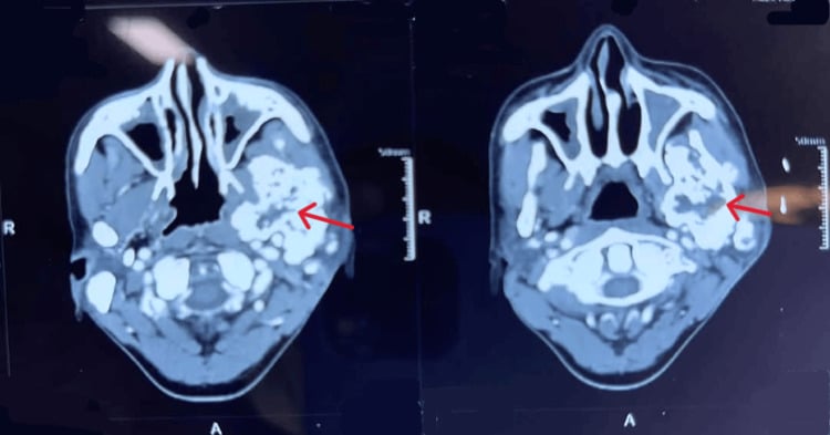 Axial PET-CT of a lytic expansile lesion in the left mandibular ramus and coronoid process
