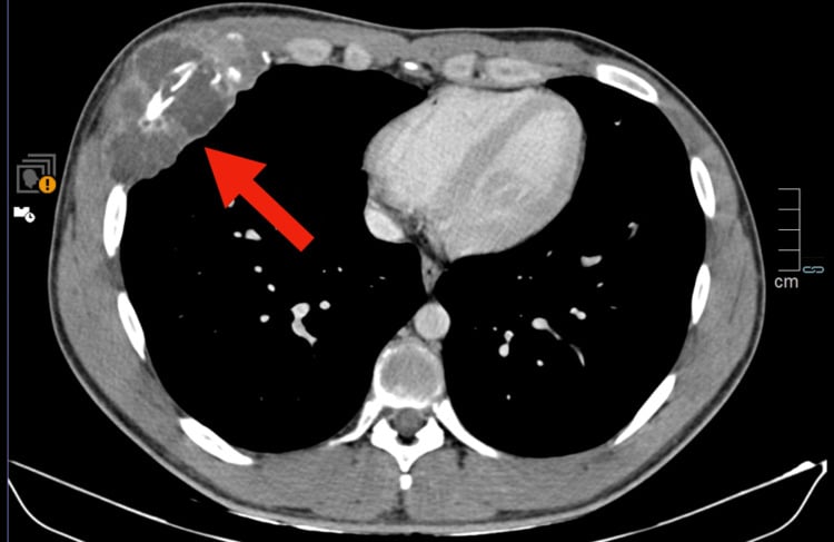 Axial contrast-enhanced chest CT showing a lytic right sixth-rib mass with a large soft-tissue component and peripheral calcification
