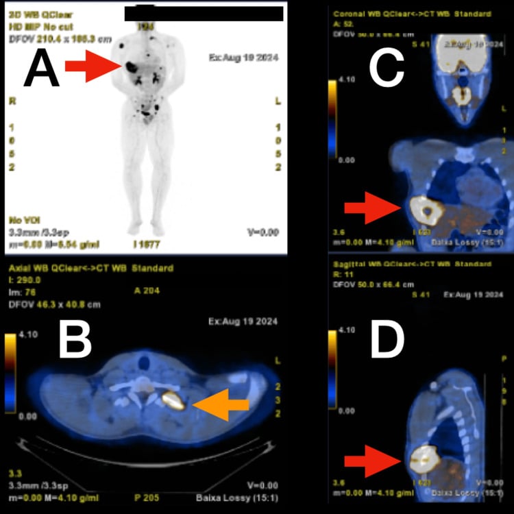 Whole-body FDG PET showing a primary rib mesenchymal chondrosarcoma with widespread skeletal metastases